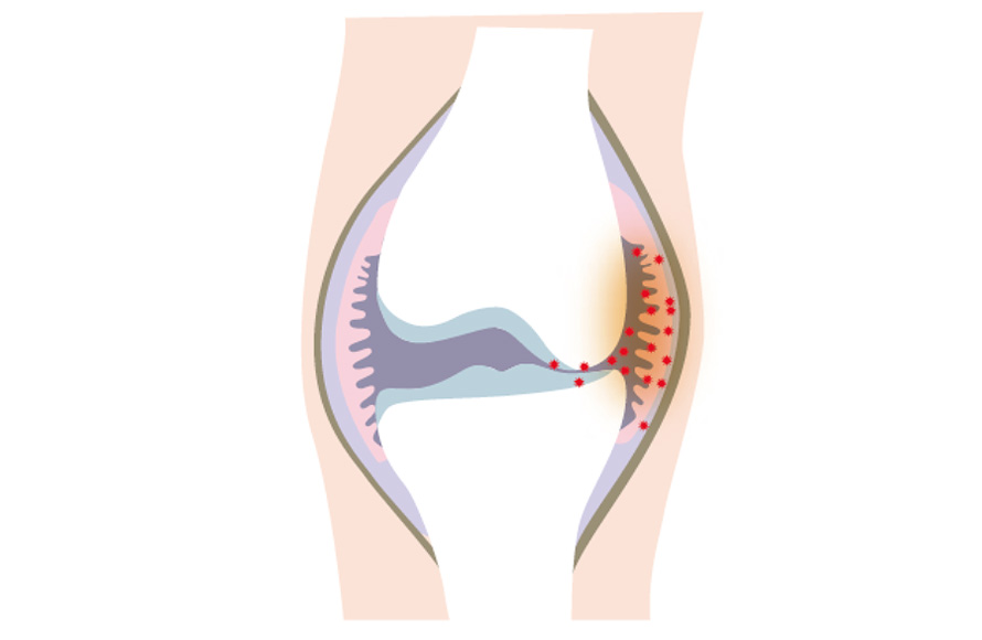 偽痛風 ぎつうふう慢性痛治療の専門医による痛みと身体のQ＆A