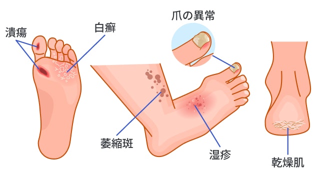 天疱瘡水疱症①看護roo! カンゴルー