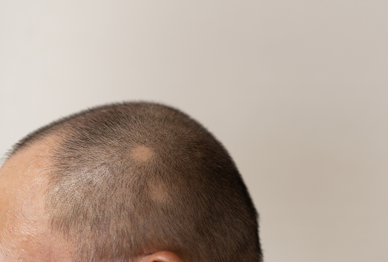 ニキビ 赤み、でこぼこ ・酒さ一般皮膚科 症状別の病名一覧渋谷スクランブル皮膚科渋谷駅徒歩1分