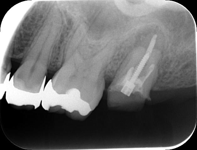 すきっ歯 空隙歯列、複数歯 の治療法紹介：ラミネートベニアによるセラミック治療さいたま市緑区・浦和区 歯医者歯科 伏見歯科医院