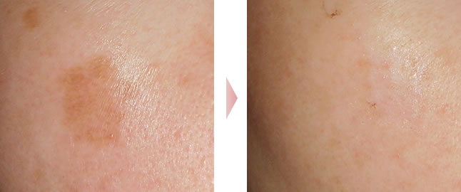 公式 鶴舞公園クリニックしみ取り・戻りジミと経過