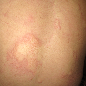 蕁麻疹の原因はストレス？湿疹との違いや治し方兵庫県川西市ことぶき皮ふ科クリニック