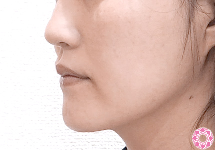 エラボト東京美容外科