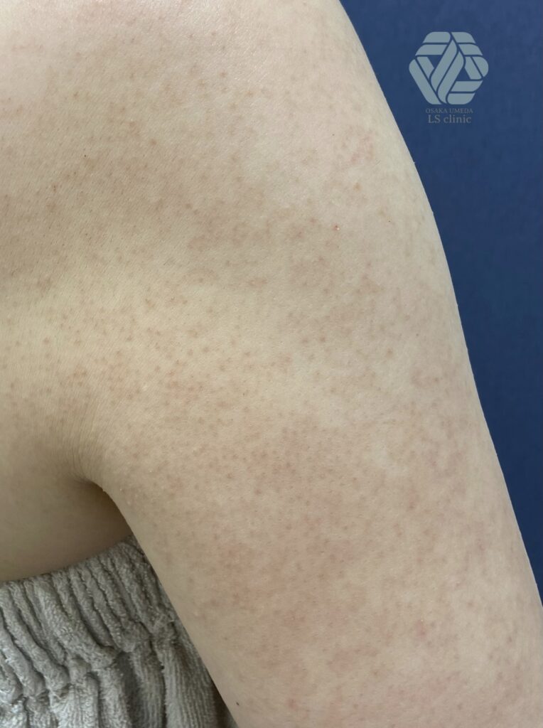 これ、実は毛孔性苔癬です👨🏻‍⚕️ , 悩んでいる方が多い毛孔性苔癬💦, 二の腕にできるのが有名ですが、顔や太もも、背中などにできる方も😔,今回は顔にできる顔面毛孔性紅斑黒皮症について解説しました🎥,毛孔性苔癬は見た目やざらつき以外は悪さをする疾患ではありませんが、気になる場合は治療でよくなる場合があります🙌,毛孔性苔癬でお悩みの際はご相談ください👨🏻‍⚕️,