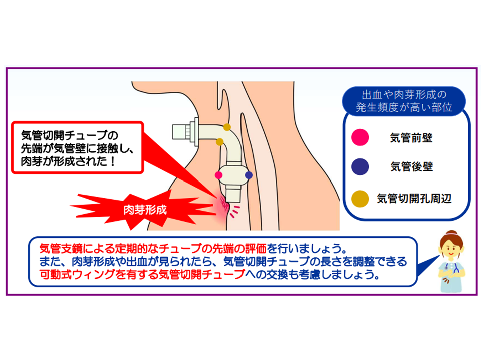 気管切開の適応とは？〜やゆさんからいただいたイラストで解説〜のうと医療専門学校