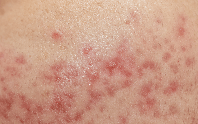 この胸ニキビはどう治していったらいいのでしょうか Ｔ_ＴQ&A - @cosme アットコスメ