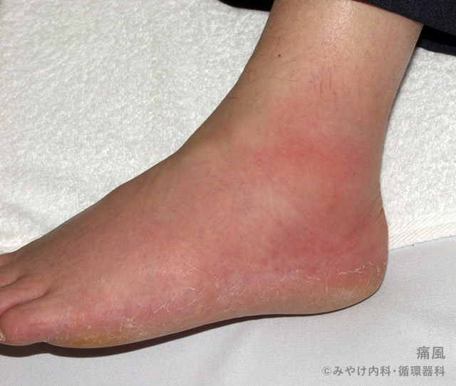 足首が痛い！内側・外側の痛みから考えられる原因と痛風の見分け方完全ガイド - 大阪鶴橋駅近く鶴橋整形外科クリニック