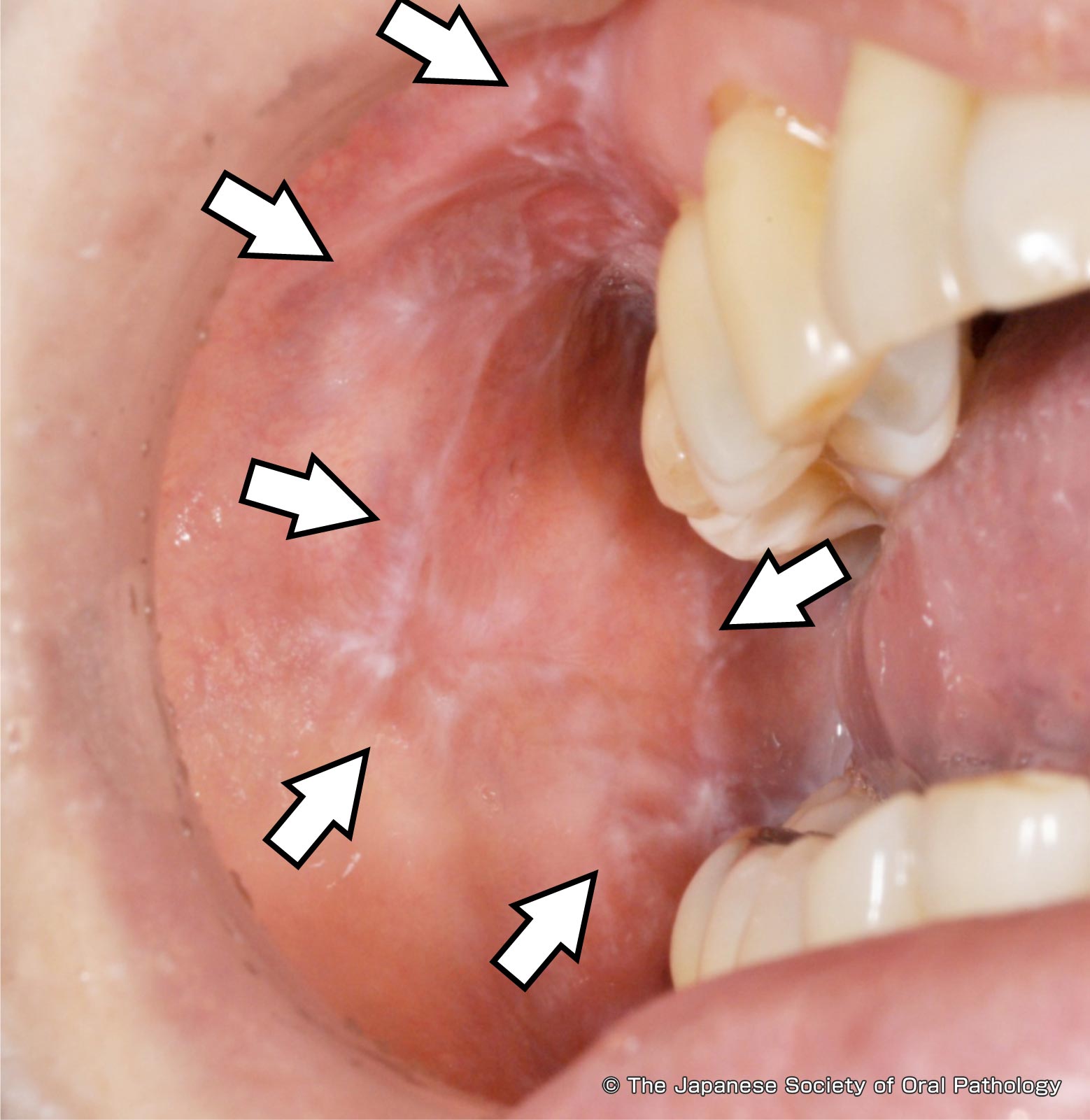 口腔扁平苔癬歯科口腔外科症例解説東京銀座シンタニ歯科口腔外科クリニック