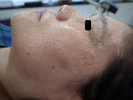 顔のブツブツはニキビじゃない？赤い・かゆい・白いなど症状別の治し方 美容のきほん 美容メディアVOCE ヴォーチェ