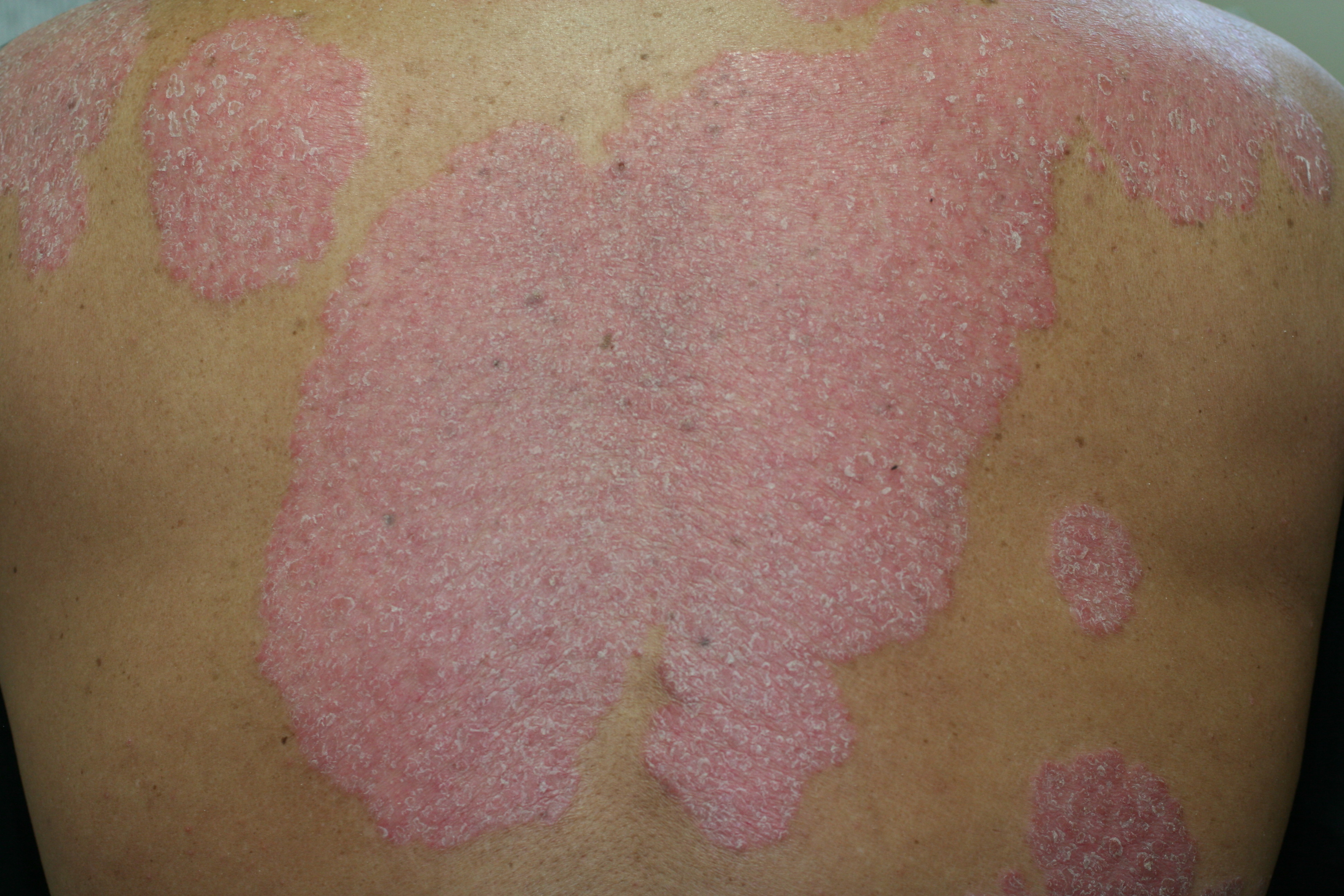 背中のアトピー・痒疹大阪・茨木市 重度のアトピー専門鍼灸 悠々堂まき鍼灸院