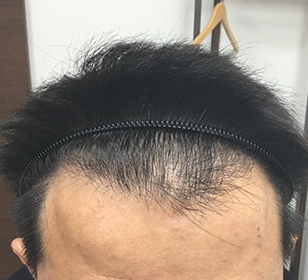 生え際が薄いと感じたら 薄毛チェックをしてみよう薄毛対策室 バイオテック 株式会社バイオテック