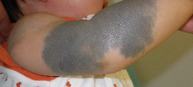 蒙古斑、毛孔性苔癬も綺麗にボディーメイクカバー - kiyo - エアブラシアートスクール大阪＆三重