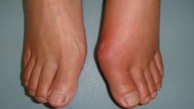 痛風・高尿酸血症恵比寿クリニック