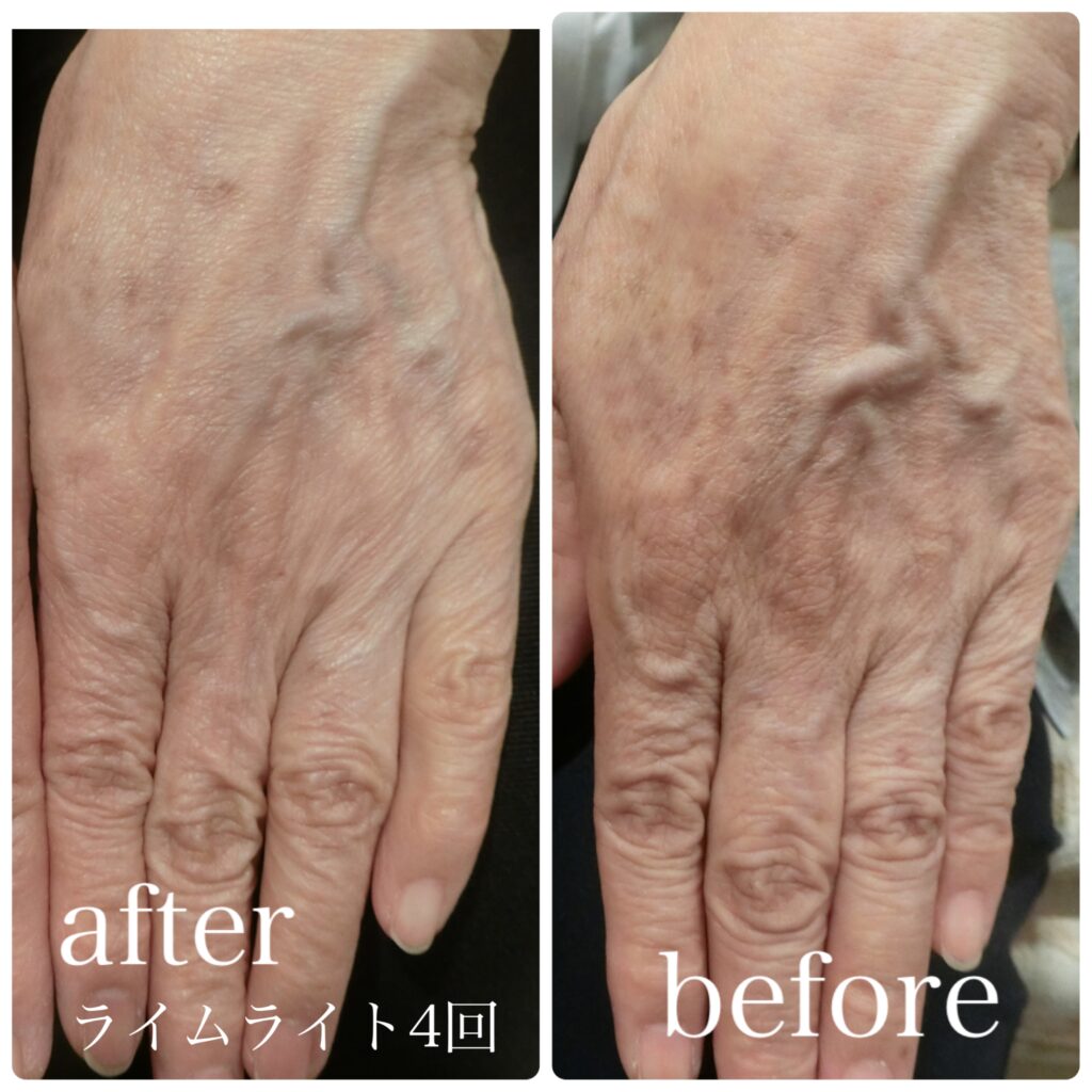 手に付いた黒クルミの染みを取り除く方法 : r foraging