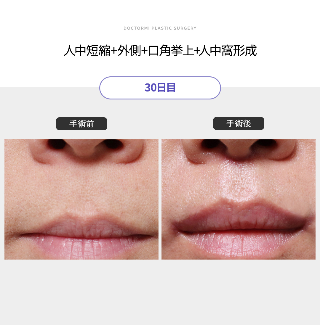 鼻の下を短くするには？切らないで人中を短くする方法はある？│SELECT CLINIC TIPS