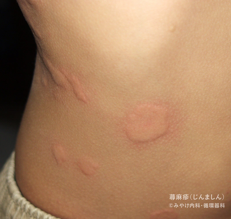 発熱やのどの痛み、発疹などの症状が出る感染症 溶連菌感染症 - Medical Terrace -メディカルテラス