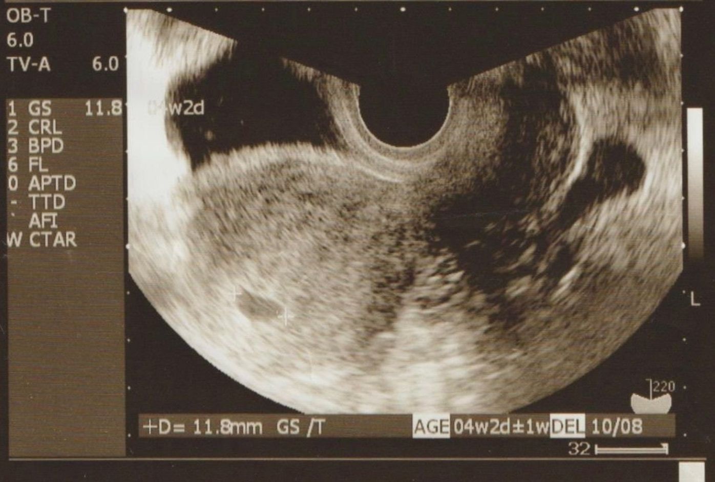 お腹の赤ちゃんドック 胎児ドック について