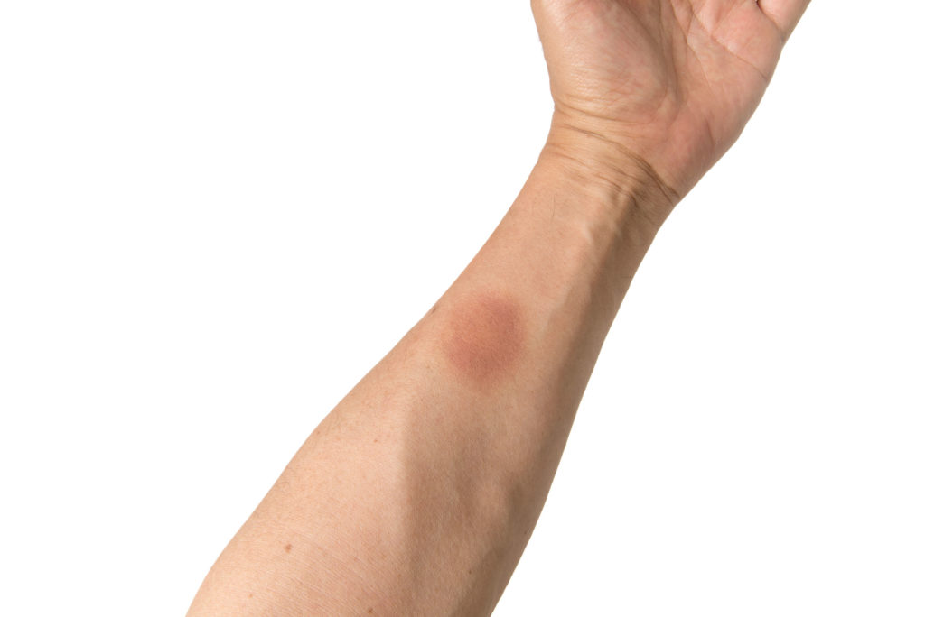 黒あざのレーザー治療・除去手術レーザー治療・手術による黒あざ 色素性母斑 除去池袋の美容皮膚科・美容外科ならみずほクリニック