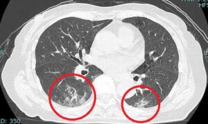 肺の聴診③副雑音～断続性ラ音～都内の在宅医療・訪問診療医療法人社団 鳳優会 ほうゆうかい