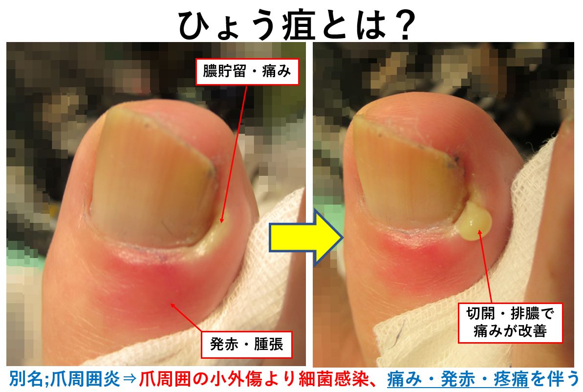 ひょう疽 爪周囲の細菌感染 たかはし皮膚科
