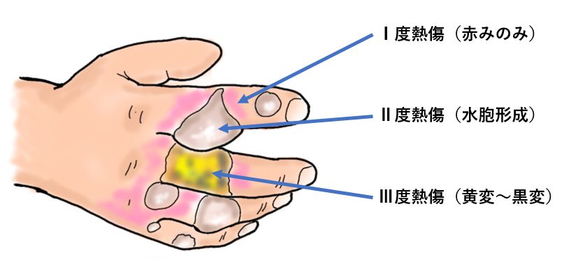 クイックパッド製品情報救急絆創膏の阿蘇製薬株式会社