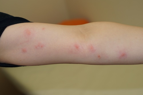 虫刺され三木市の皮膚科・美容皮膚科 さかい皮フ科クリニック