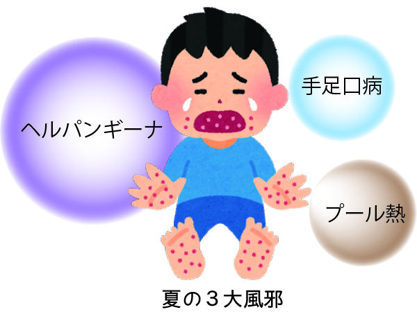 子どものホームケアの基礎ヘルパンギーナ