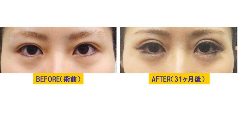 メガネスーパーが両眼での見え方のバランスにこだわる理由メガネスーパー 眼鏡 めがね、メガネ ,コンタクト,サングラス,補聴器販売