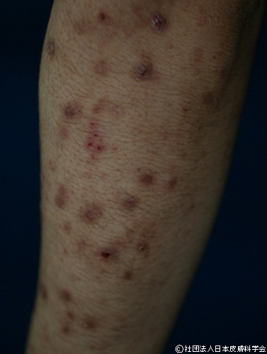 接触皮膚炎 かぶれこばとも皮膚科栄駅 名古屋市栄区 徒歩2分