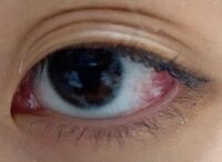 まぶたの病気三重県四日市市の眼科大川眼科