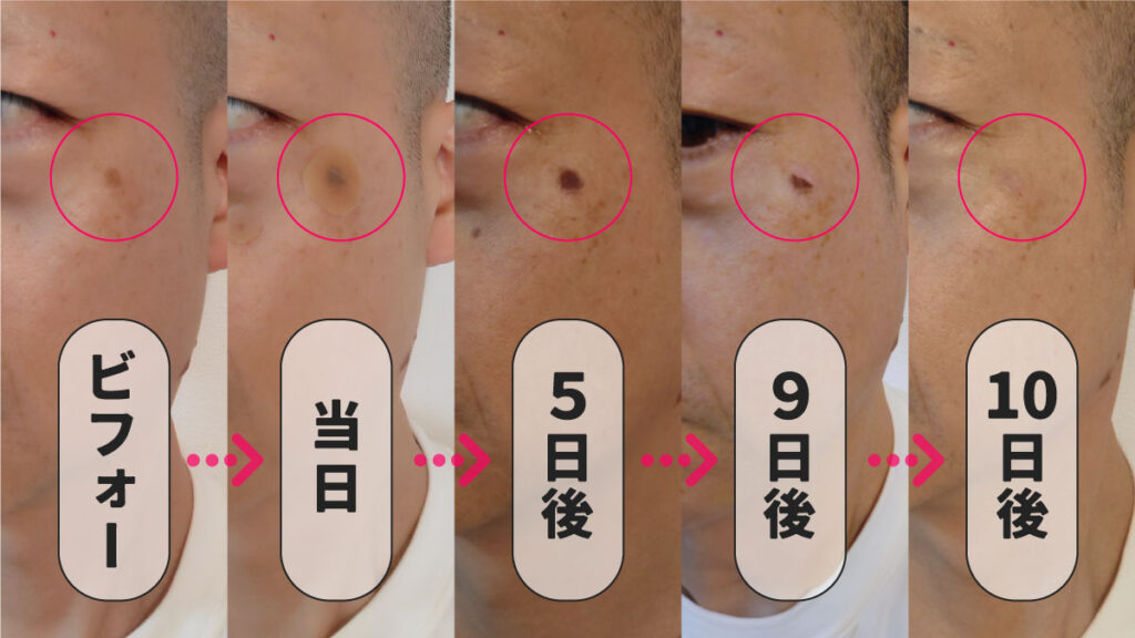 シミのレーザー治療後の経過・炎症後色素沈着を検証してみたBeauty Tuning Clinic