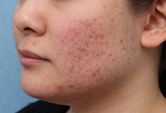 写真でわかる ニキビ跡の種類4つと治療法を医師が解説リゼの美肌治療