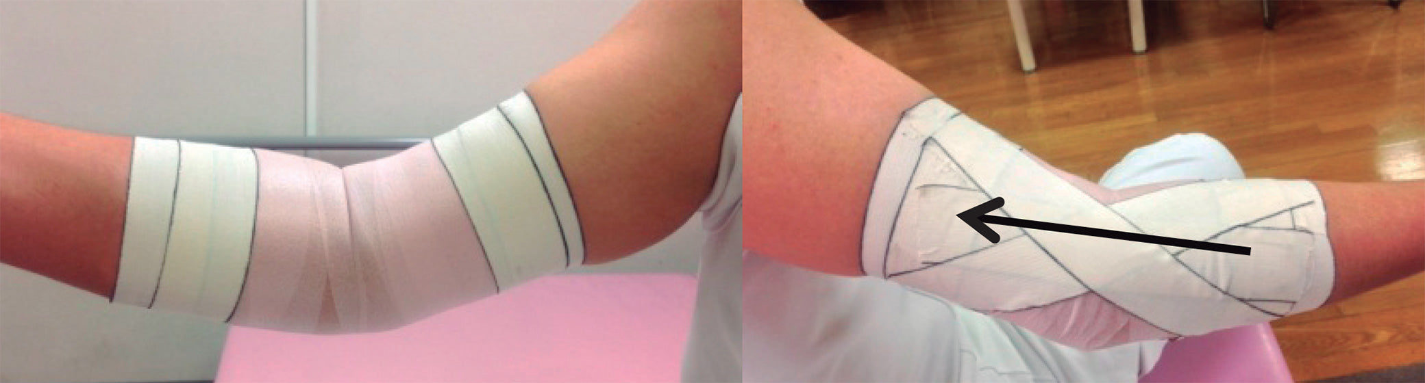 バネ指のテーピング簡単