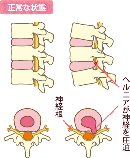 頚椎椎間板ヘルニア藤枝平成記念病院