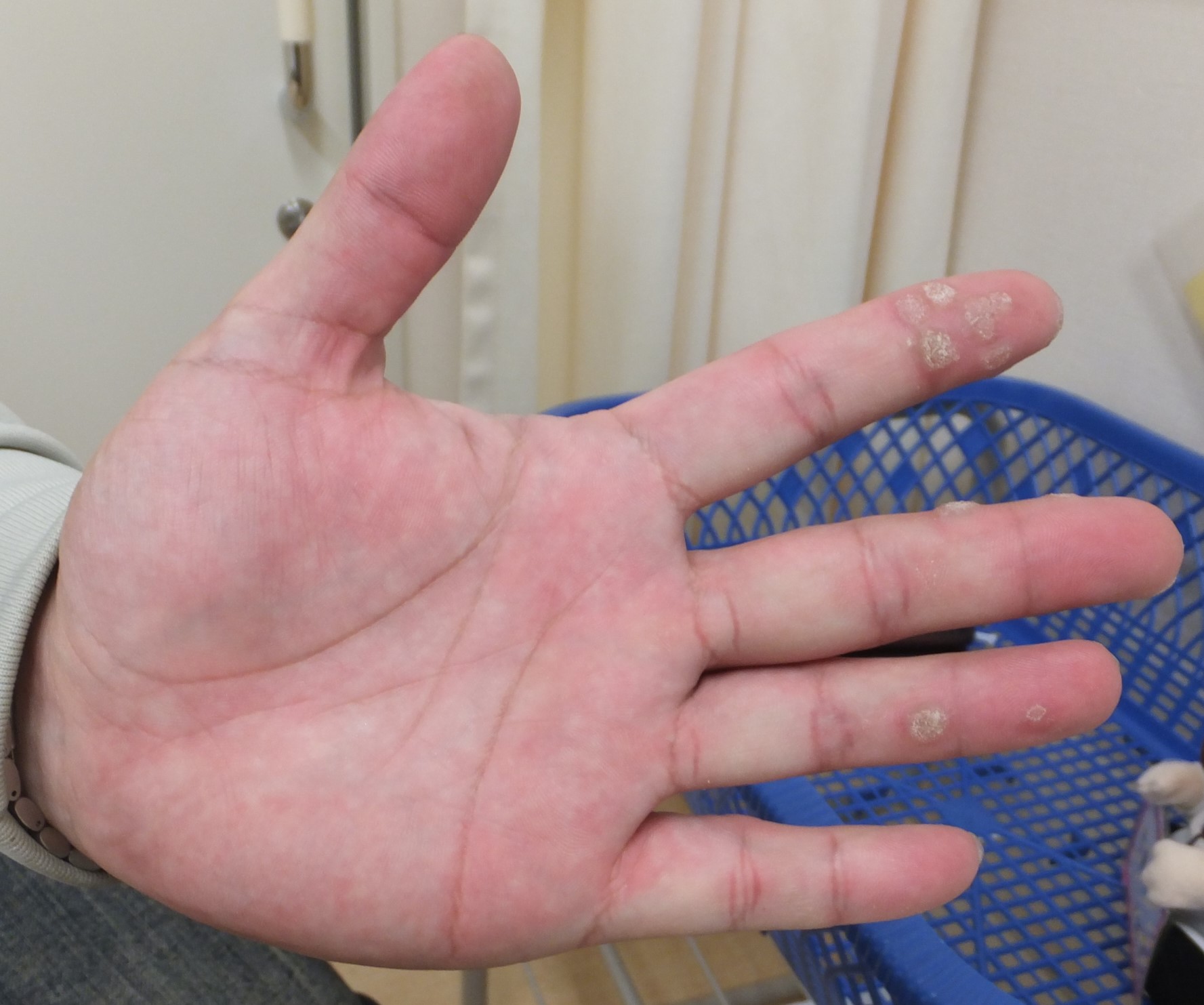 毎日が帯状疱疹!？チョロい疾患と侮るなかれ 3ページ目 ：日経メディカル