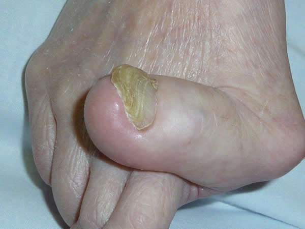 爪の病気 Q21 - 皮膚科Q＆A 公益社団法人日本皮膚科学会