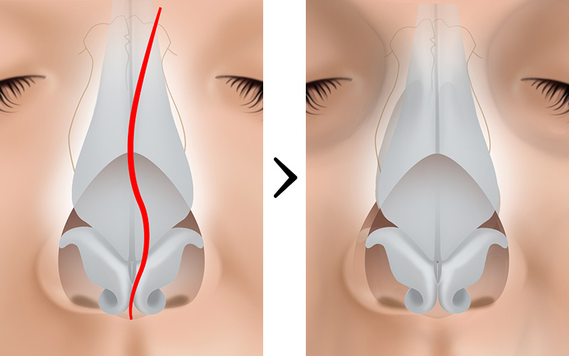 曲がった鼻を美しく整える手術・斜鼻修正：美容外科 高須クリニック