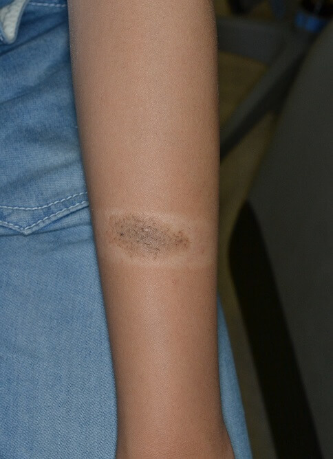 生まれつきの黒あざの手術 症例写真ふじた形成外科・皮膚科クリニック長野県松本市イオンモール晴庭3Fあざ ・しみ・ほくろレーザー治療・ニキビ・脱毛