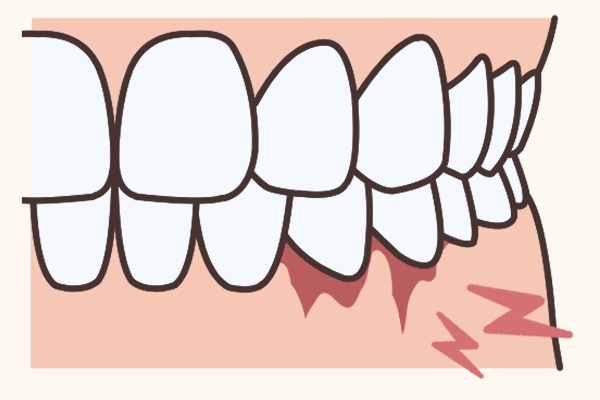 歯齦炎」の1.5万点のロイヤリティフリー画像、写真素材、絵Shutterstock