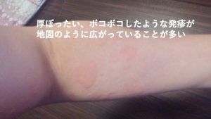 湿疹、かぶれ新鎌ケ谷くぼた皮膚科泌尿器科鎌ケ谷市の皮膚科・泌尿器科