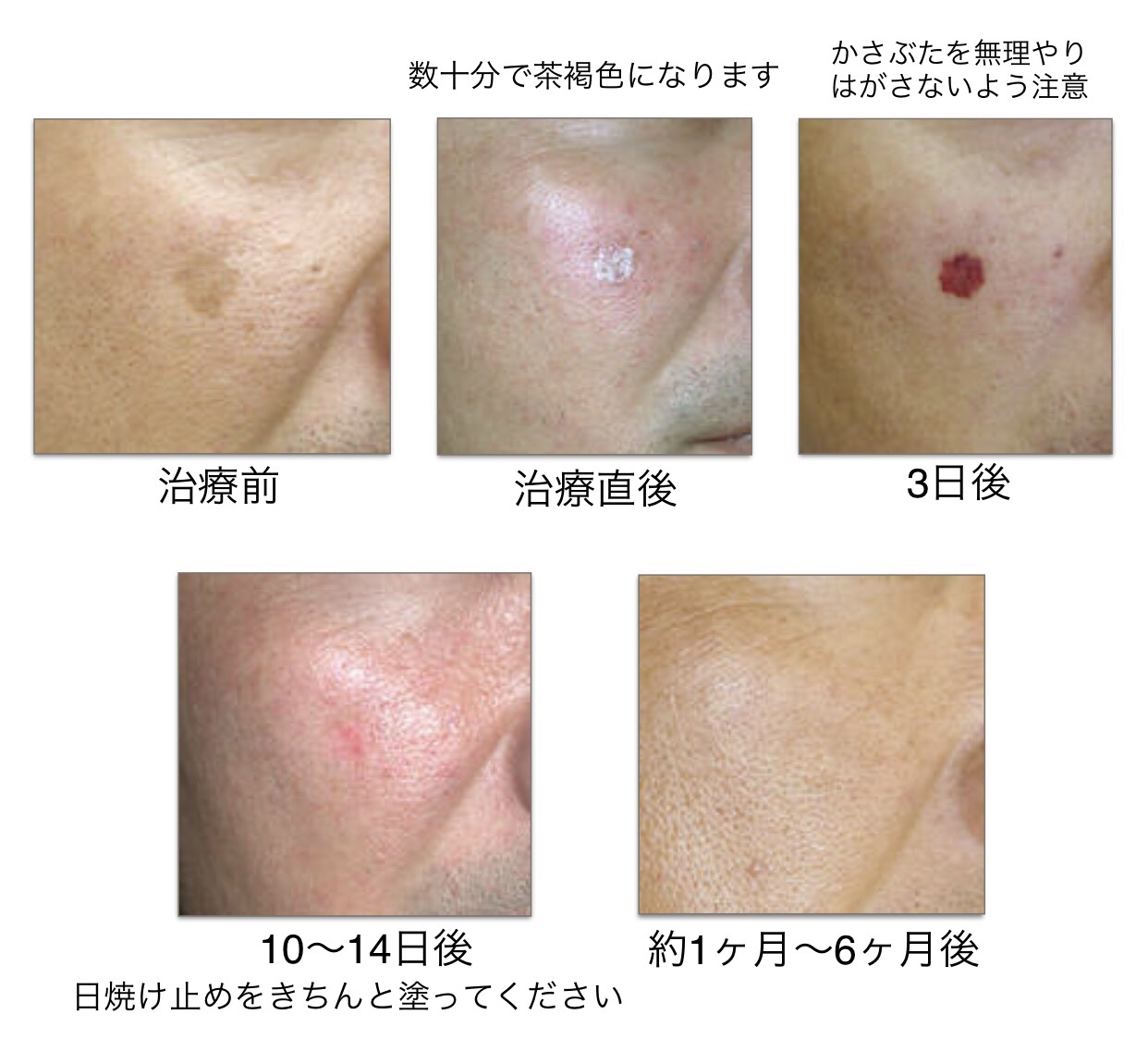 シミ取り治療経過 レーザー治療は何日でキレイになる？ダウンタイムや注意点を詳しく解説 - YouTube