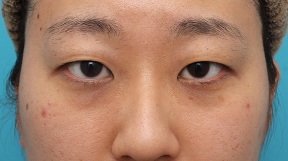 まぶたの腫れについて 赤ちゃんの病気・ケガ ベビーカレンダー専門家相談