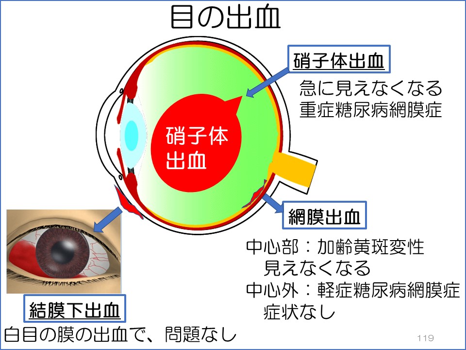 早く眼科を受診した方がいい充血とは？医者が教える病気のブログ