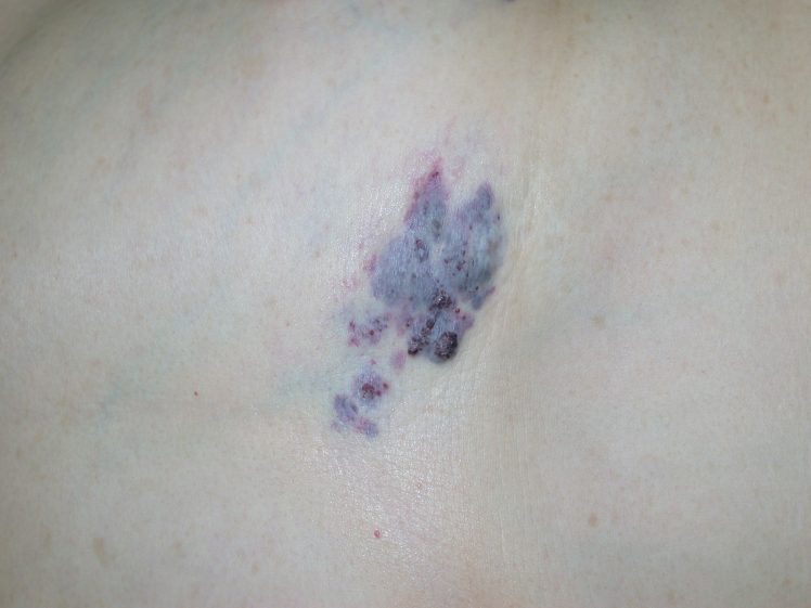 あざ - 牛込パーククリニック