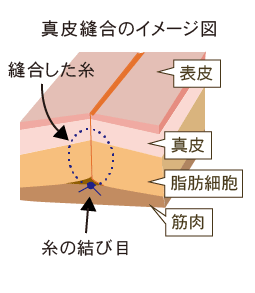 真皮縫合 実は「糸結び」が7割 〜 素人はココが解っていない手術上手くなる研究所 BUYSS labo 01