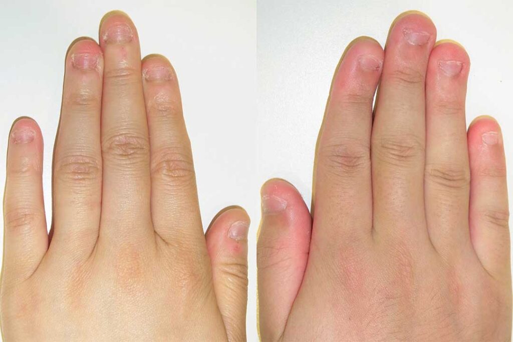 発達障害の子育てサポート 爪かみがひどい小２の娘。エスカレートして定規なども噛むようにHugKum はぐくむ