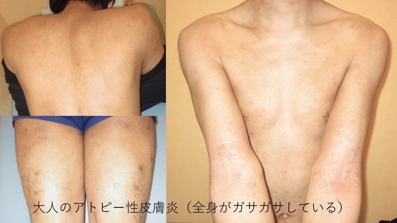 アトピー性皮膚炎千葉県船橋市北習志野のふじもと皮膚科クリニック