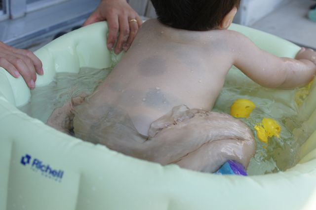 異所性蒙古斑あざ治療の専門クリニック西堀形成外科