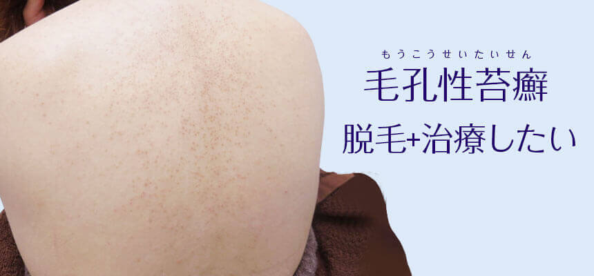 スタッフ体験談 毎年悩む「背中ニキビ」私はこれで解決しました