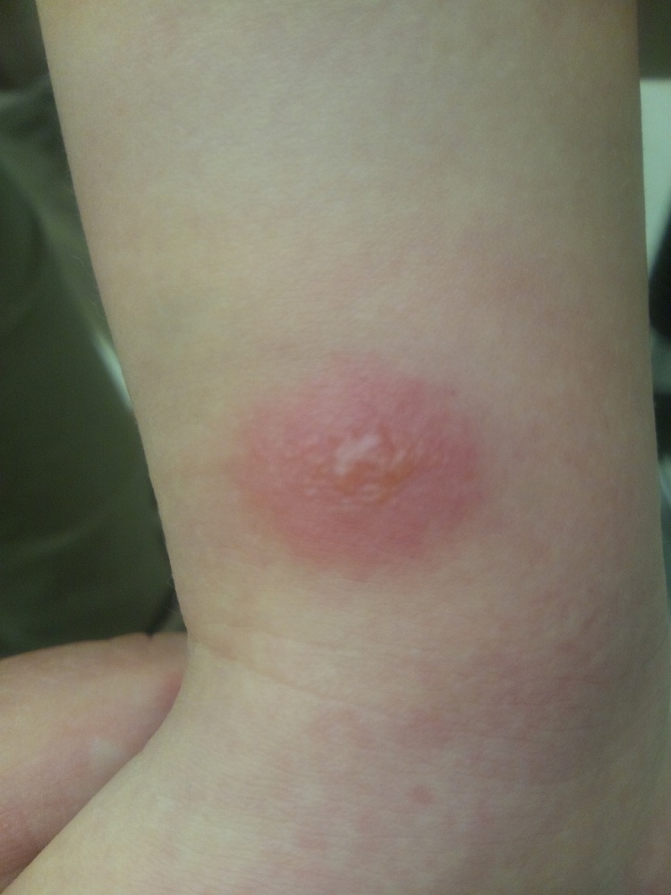 虫刺されで水ぶくれができた際の処置は？虫別の対処法・注意点を医師がわかりやすく解説皮膚のトラブル解決のための情報メディア-皮膚科Medi